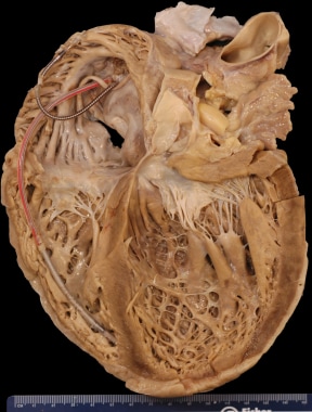 Gross heart specimen from a patient with dilated c