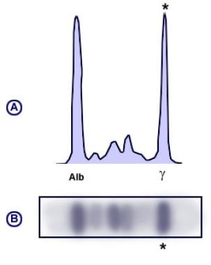 Monoclonal pattern serum protein electrophoresis (