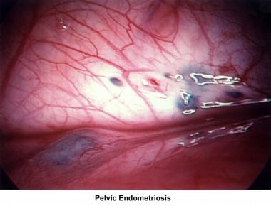 Infertility. Pelvic endometriosis. Image courtesy 