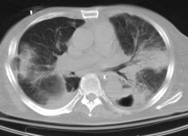 This chest CT scan was obtained on the same day as
