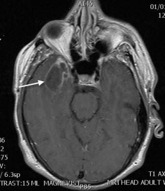 Cerebral abscess. This T1 contrast-enhanced MRI of