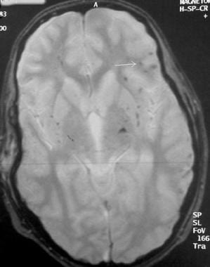 Gradient-echo axial magnetic resonance image demon