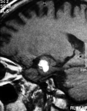 Sagittal T1-weighted MRI shows hemorrhage in a hug