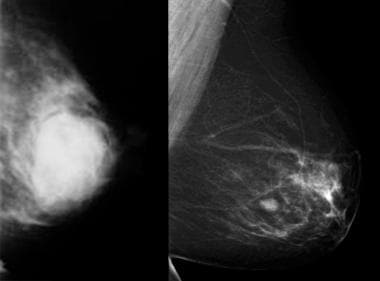 Image from a mammogram shows a benign mass: a fibr