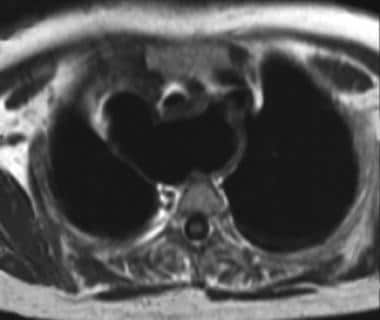 Axial T1-weighted MRI of the chest (obtained with 