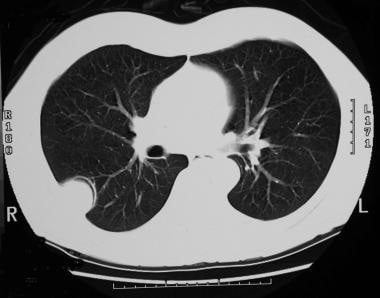 Solitary pulmonary nodule. Neurilemoma - Lung wind
