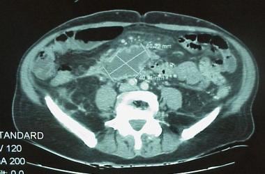 CT scan demonstrates the large size of this pseudo