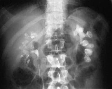 Radiograph from an intravenous urographic series i