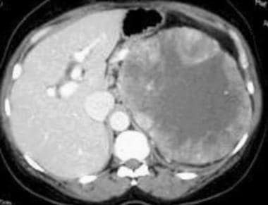 Case 7. Multifocal renal cell carcinoma. Contrast-