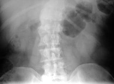 Scout radiograph in a 53-year-old man presenting w
