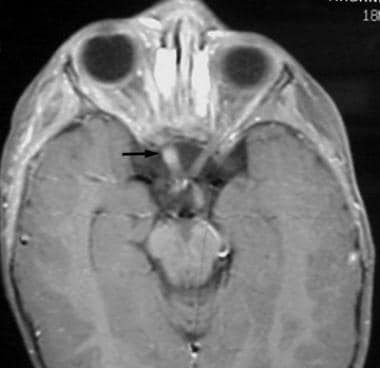 Axial postgadolinium T1-weighted MRI with fat satu