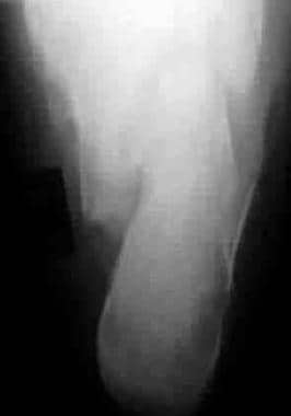 Calcaneus, fractures. Axial (Harris) view demonstr