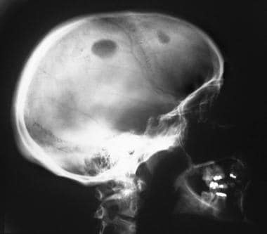 Eosinophilic granuloma. Lateral skull radiograph i