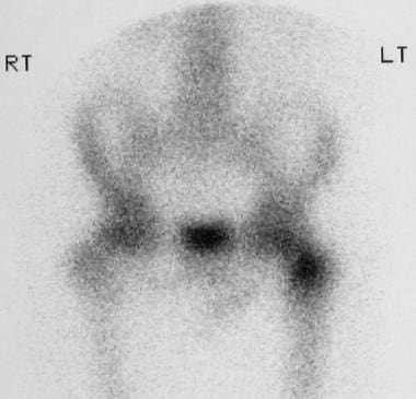 Radioisotope bone scan in a 6-year-old child who p