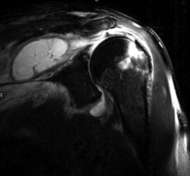 Coronal T2-weighted fat-saturated MRI of the shoul