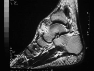 Sagittal T2-weighted magnetic resonance image of t