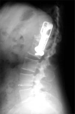 Lumbar spine trauma. Lateral radiograph demonstrat