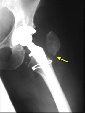 Image from a patient who had a prosthesis failure 