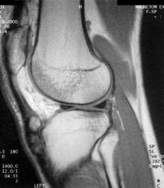Extensor mechanism injuries of the knee. Osteochon