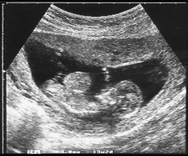 Sagittal antenatal scan in a 13-week-old fetus sho