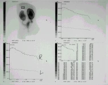Renal scanning images performed with diethylenetri