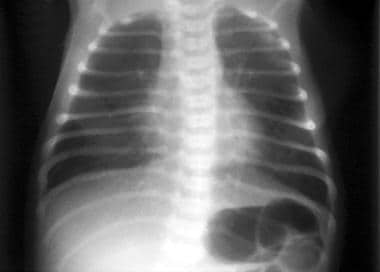 Chest radiograph of a neonate at age 2 days. Moder