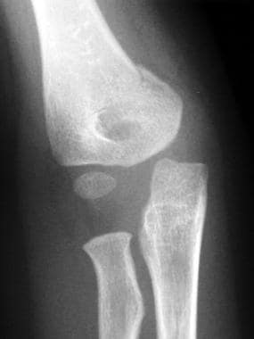 Supracondylar fracture. Anteroposterior view shows