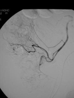 Postembolization selective angiogram in a patient 