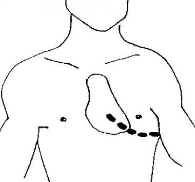 A skin incision is made above the fifth rib into t