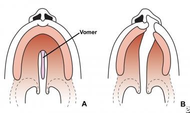 Variations of cleft palate. 