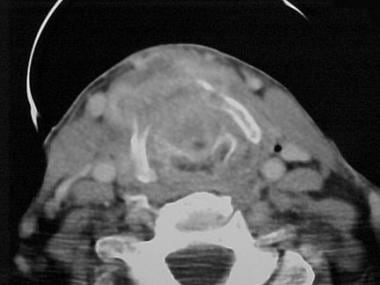 The tumor shown in the images above is seen in a p