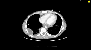 CT scan of the thorax with intravenous contrast of