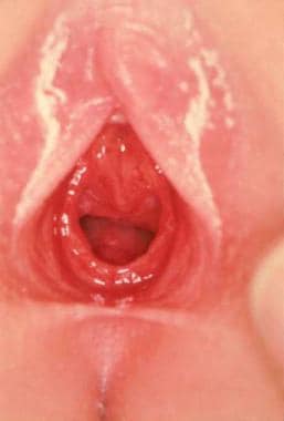 Increased genital erythema can be caused by local 