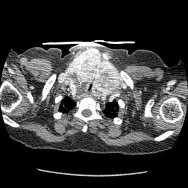 CT scan of substernal goiter with tracheal compres