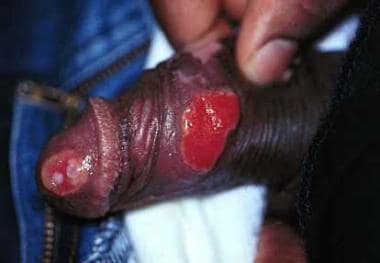 Beefy-red penile ulcers. 