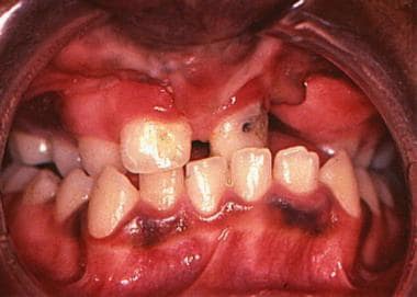 Intraoral melanoacanthoma lesion on the mandibular