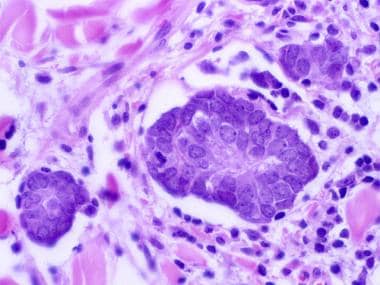 Pseudorosette formation in Merkel cell carcinoma. 