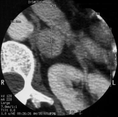 Close-up of the left adrenal incidentaloma from th