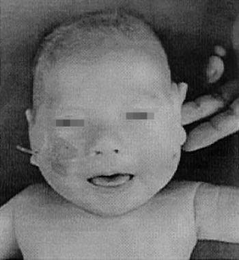 Four-month-old patient with classic Menkes disease