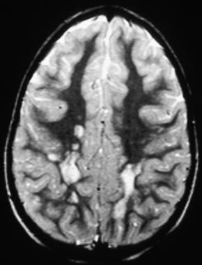 T2 axial section of an MRI through the cerebral he