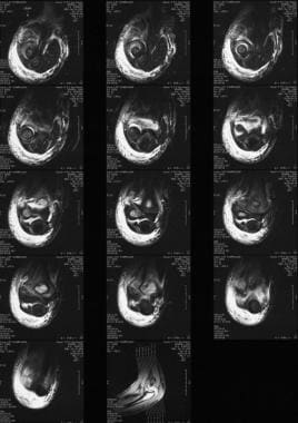 MRI demonstrating Milch type II fracture pattern. 