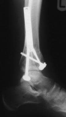 Pilon fracture stabilized with cannulated screws. 