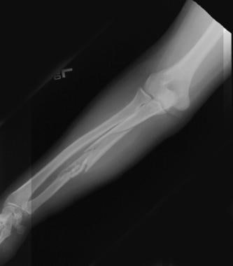 Middle-third forearm fracture. 