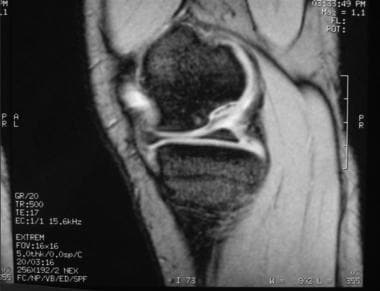 Osteochondritis dissecans. MRI sagittal view of an