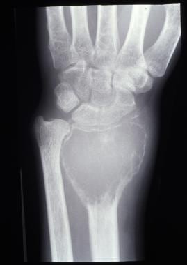 Giant cell tumor. Anteroposterior radiograph of di