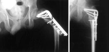 Fracture around plate implant treated with rigid r