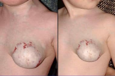 The effect of compression on a chest hemangioma. 