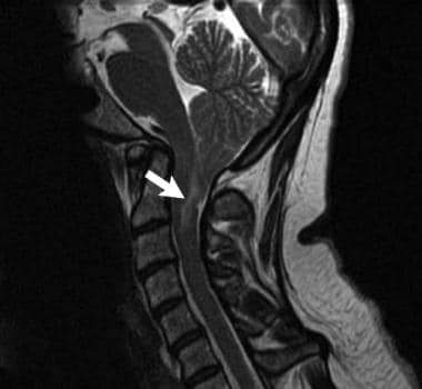 T2 hyperintense region on MRI (arrow) depicting ed