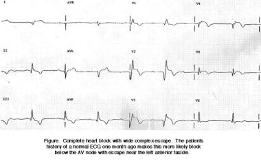 Atrioventricular Block, Heart Block