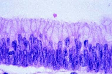 Histology of villous adenoma. Low-grade dysplasia 
